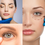 Blefaroplastia precio